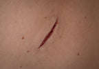 Stichwunde B - HD Prosthetics